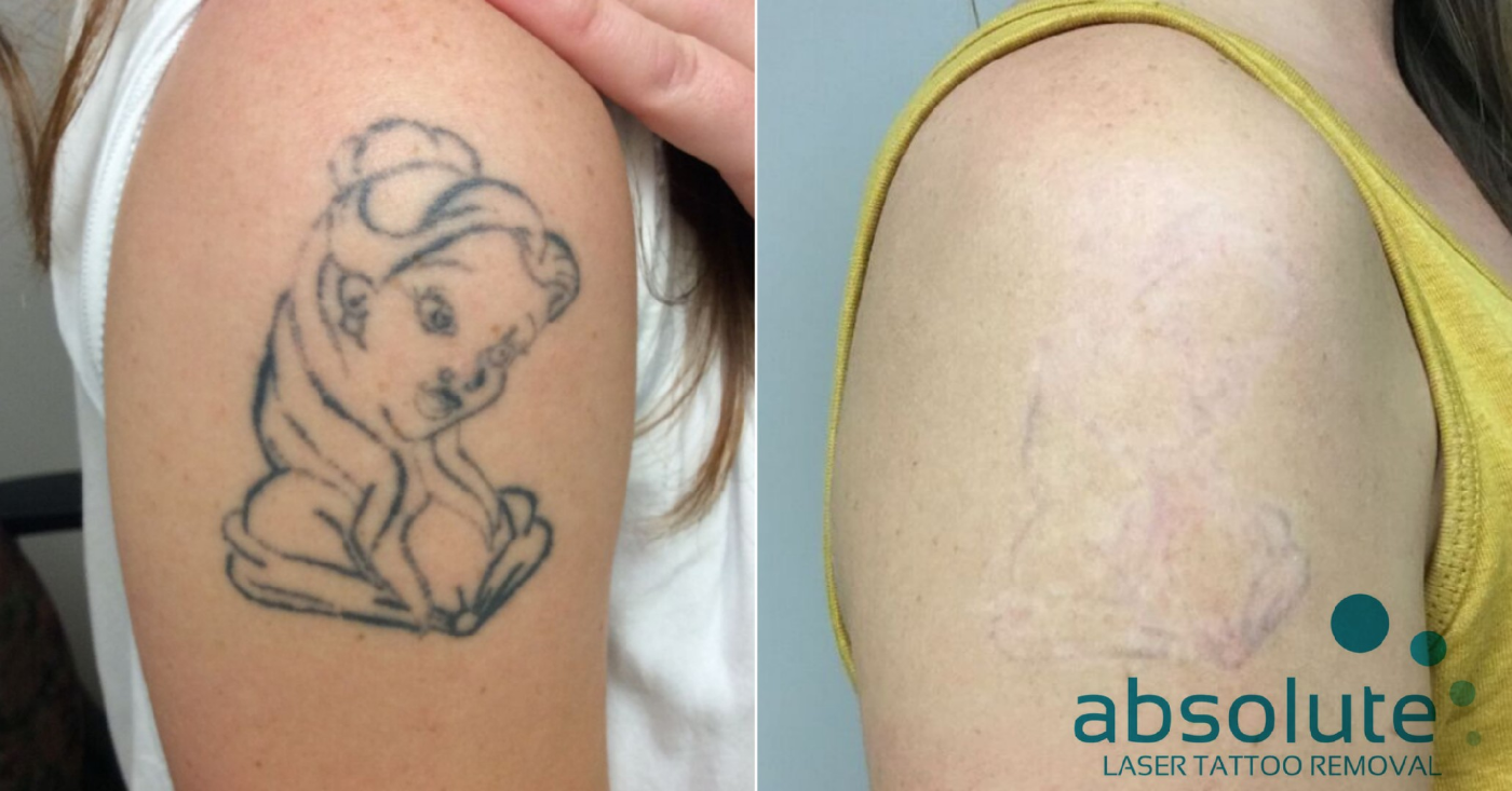 Comparing Tattoo Removal Cream with Laser Removal  San Diego Dermatologist