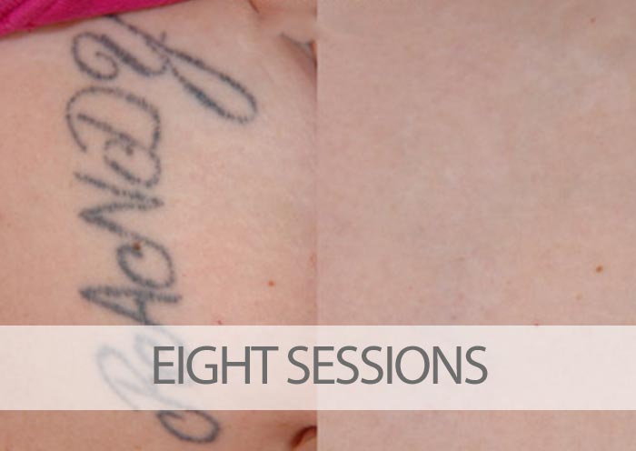 Perfectly Bare Laser  Tattoo Removal  Tampa FL  2023