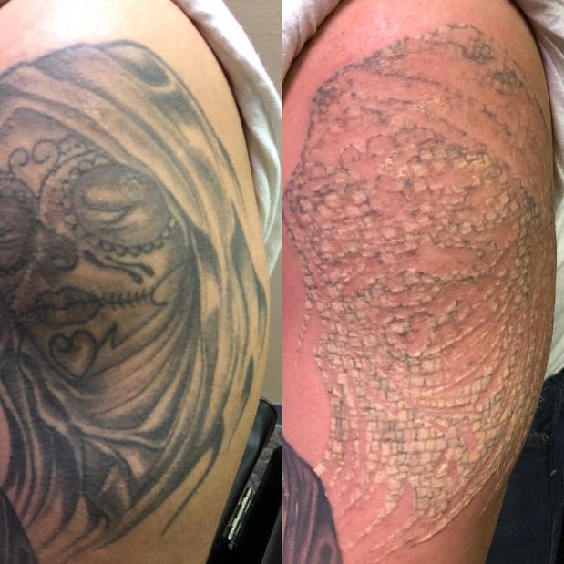 Before  After Laser Tattoo Removal  El Paso TX  Company Page