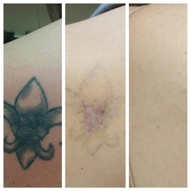 Louisville Tattoo Removal  Expert Laser Ink Removal