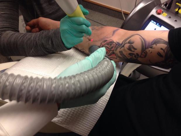 Try Before Your Cover Up  Lexington Tattoo Removal