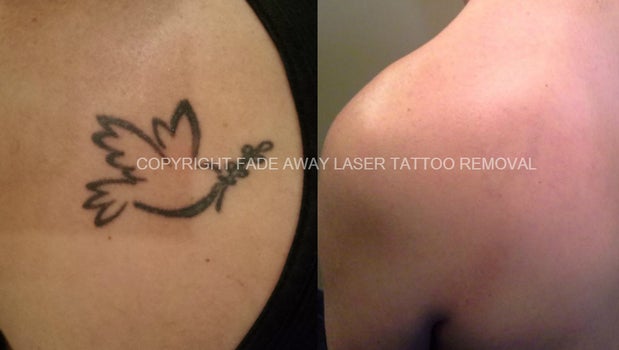 Safe and Effective Laser Tattoo Removal  PryorHealth  Medspa