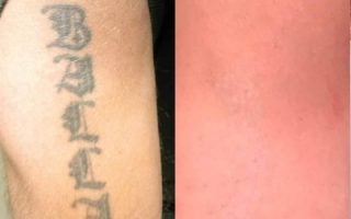 Why OPM Eraser System Is The Tattoo Correction And Removal You Need