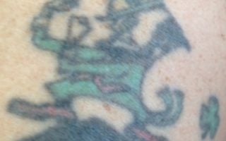 Laser Tattoo Removal in Birmingham AL