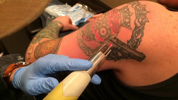 Tattoo removal  rtattooadvice
